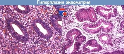 angiofibromul celular cu hiperplazie atipică